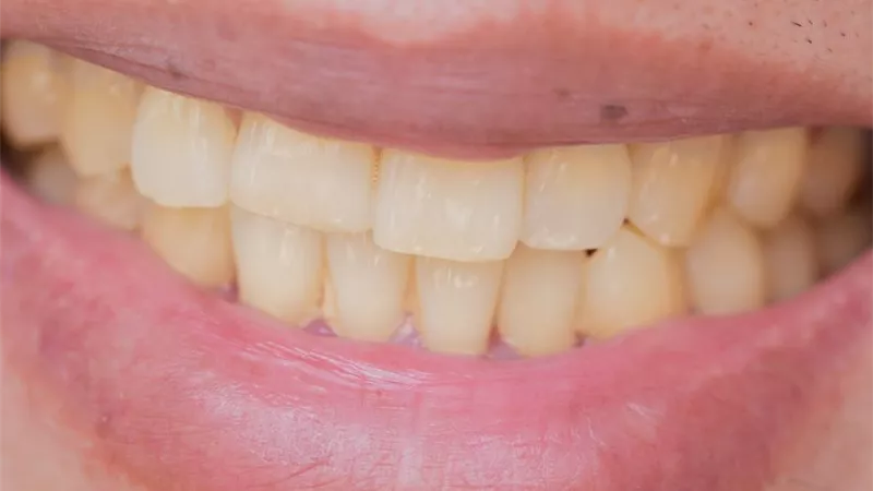 ألوان أسنانك.. علامات خفية قد تنذرك بمخاطر صحية
