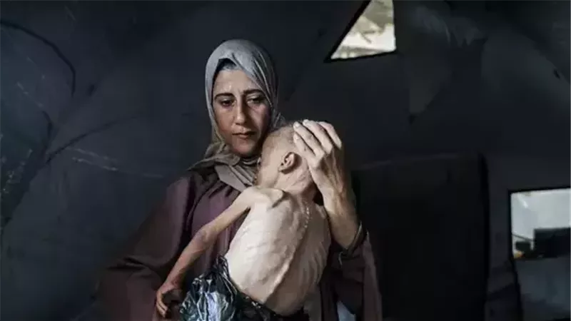 قصة مرض الهزال.. بعد صورة طفل غزة ضمن صور مؤثرة بـ2025