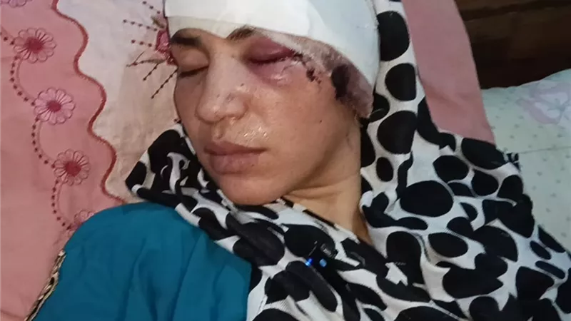 منى أم فقدت الأمان قبل ملامحها: ثمانون غرزة هدية شقيق الزوج لسيدة الزقازيق