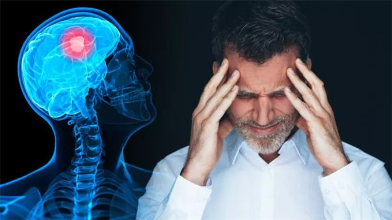انتبه لأعراض ورم المخ.. 9 علامات بارزة لا يجب تجاهلها