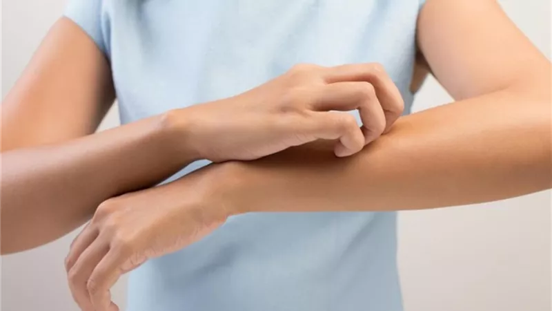 مؤشر لأمراض الكلى.. الحكة الجلدية تؤثر على الصحة العقلية