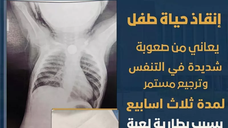 بعد ابتلاعه حجر بطارية.. إنقاذ رضيع من الاختناق بمجمع الأقصر الطبي 
