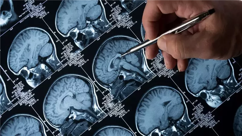  دراسة تكشف مفاجأة عن علاج الزهايمر