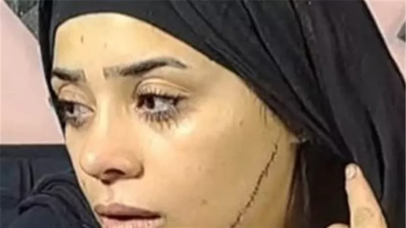 غدر وانتقام قبل الزفاف.. الحبس سنتين لسيدة شوهت وجه عروس طليقها بـ«كتر»