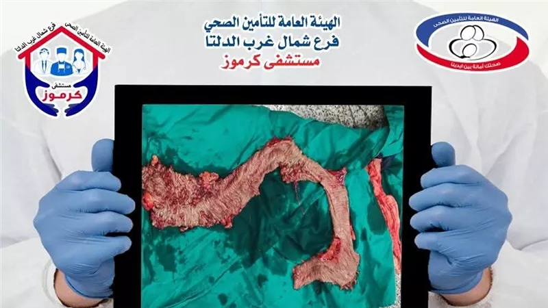 استئصال قولون مريض بمستشفى كرموز للتأمين