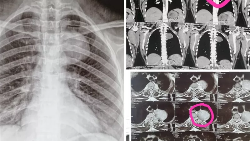 فريق طبي بمستشفى جامعة أسيوط ينجح في إنقاذ حياة أم وجنينها بإزالة ورم خطير