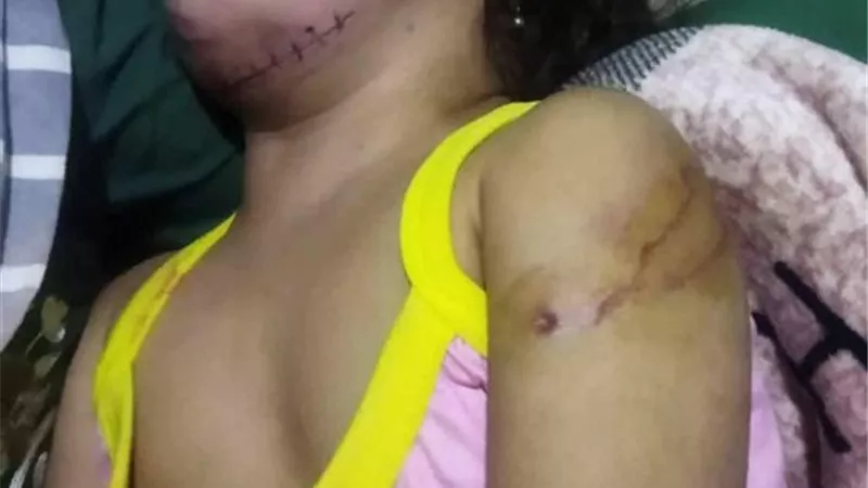 كلب ضال يعقر طفلين في تلبانة بالشرقية والأهالي يستغيثون