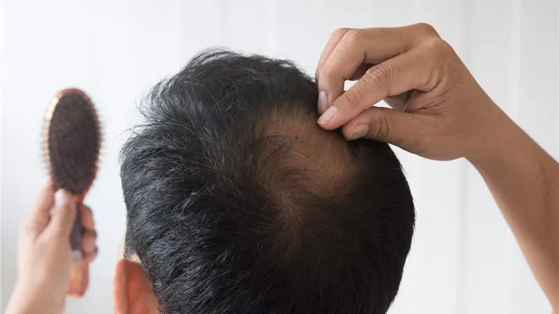 كيف حاول الإنسان إنقاذ شعره عبر التاريخ؟
