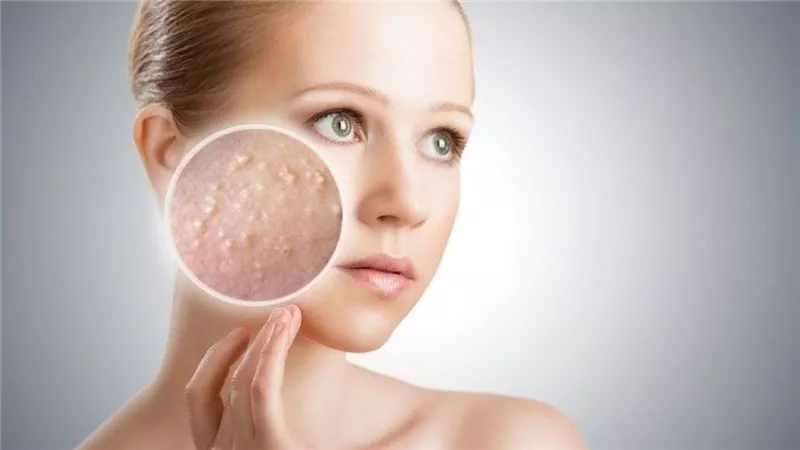 أسباب ظهور الرؤوس البيضاء.. تعرف على طريقة إزالتها من الوجه