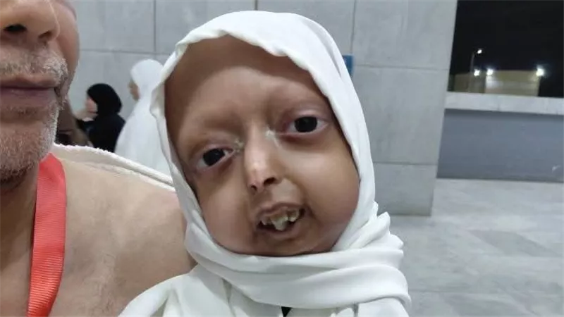 الحزن يخيم على قنا بعد رحيل «فتاة الشيخوخة المبكرة»