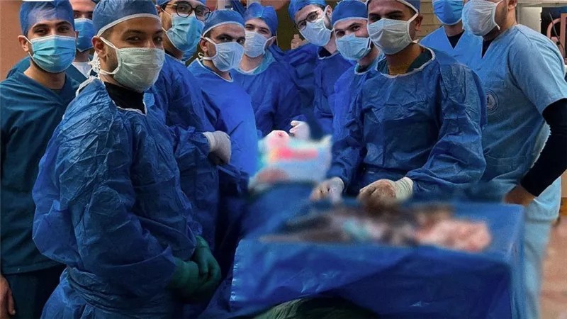  مستشفى جامعة كفر الشيخ ينجح في إجراء جراحة نادرة لتشوه بالعمود الفقري