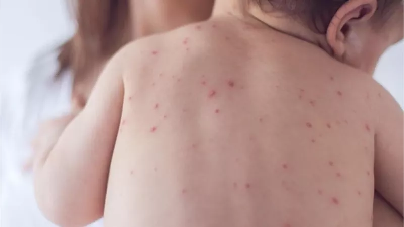الحصبة تتراجع عالميا.. خطر العودة يلوح مع تراجع التطعيم