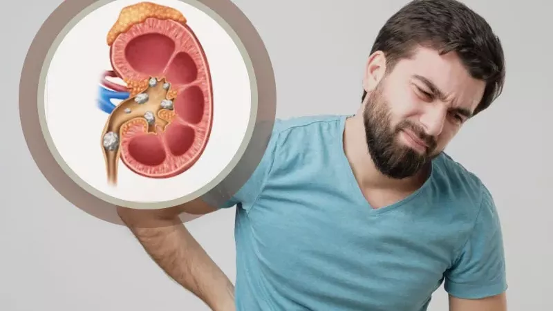 دراسة: ارتفاع حصى الكلى بسبب الجفاف والإفراط في تناول طعام غني بالملح