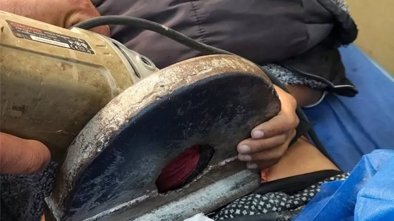 مستشفى الأزهر بدمياط ينجح في استخراج منشار كهربائي من بطن طفل