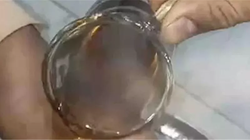 تحذيرات من خطورة تريند «كوباية الشاي».. حروق خطيرة ومضاعفات صحية