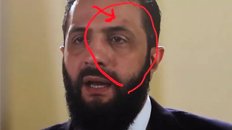 فيديو يثير ضجة.. كدمات على وجه أحمد الشرع تشعل الجدل