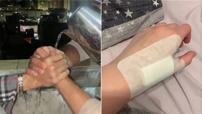 نقابة الأطباء تحذر من تحدي «الماء المغلي»: يسبب أضرارا صحية خطيرة