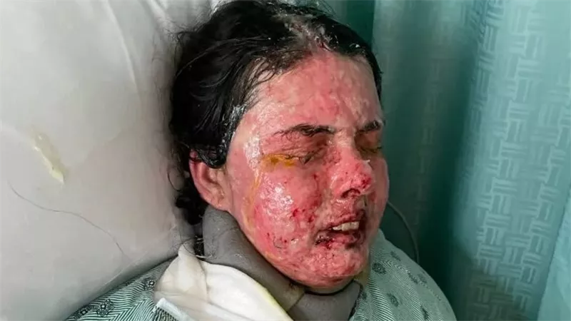 بسبب الصرع.. امرأة يحرق جسدها وتصاب بالعمى|صور