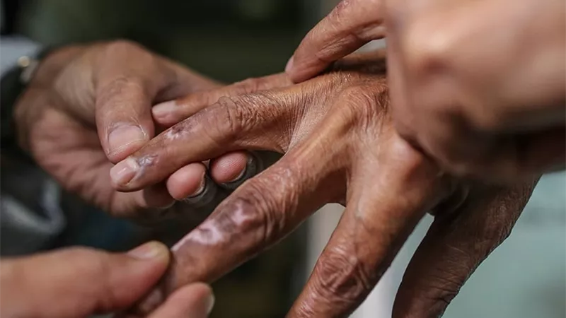 اليوم العالمي للجذام.. مرض قابل للعلاج والكشف المبكر يصنع الفارق