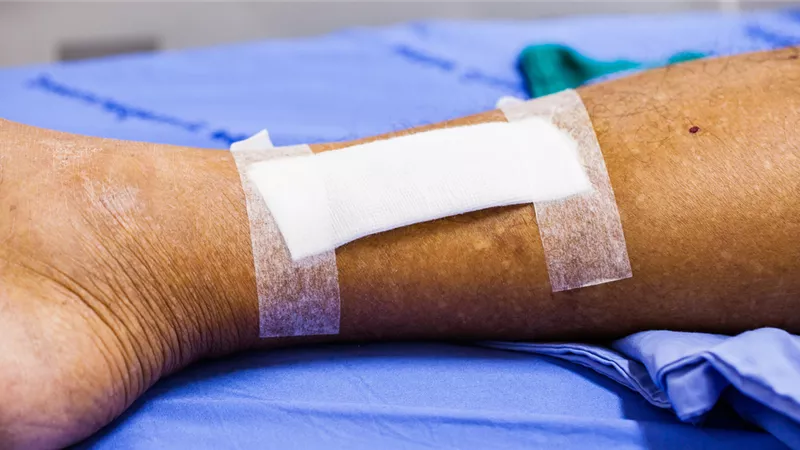 «الصحة»: 4 حالات حروق تستدعي التوجه الفوري للمستشفى