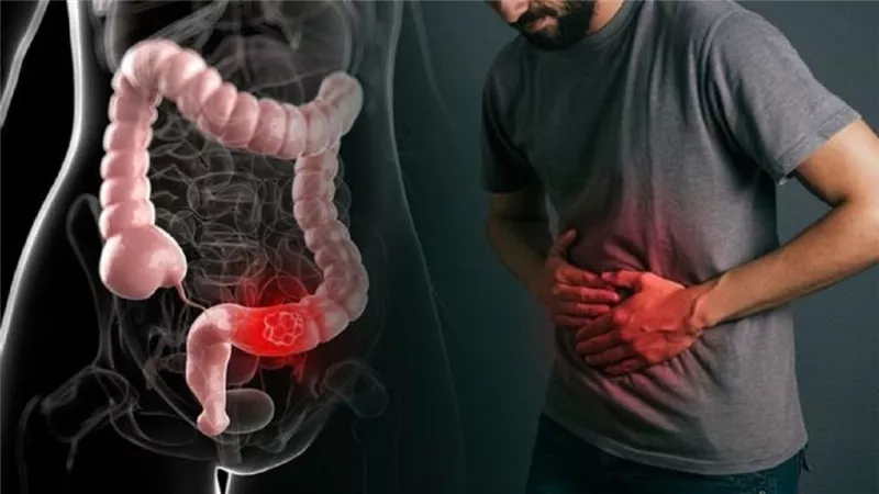 القولون العصبي والضغط النفسي.. علاقة وثيقة وتأثيرات صحية معقدة
