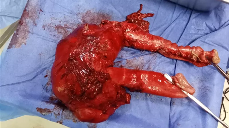 نجاح جراحة دقيقة لاستئصال ورم بالقولون يزن 7 كيلو جرام بمستشفى الفيوم العام 