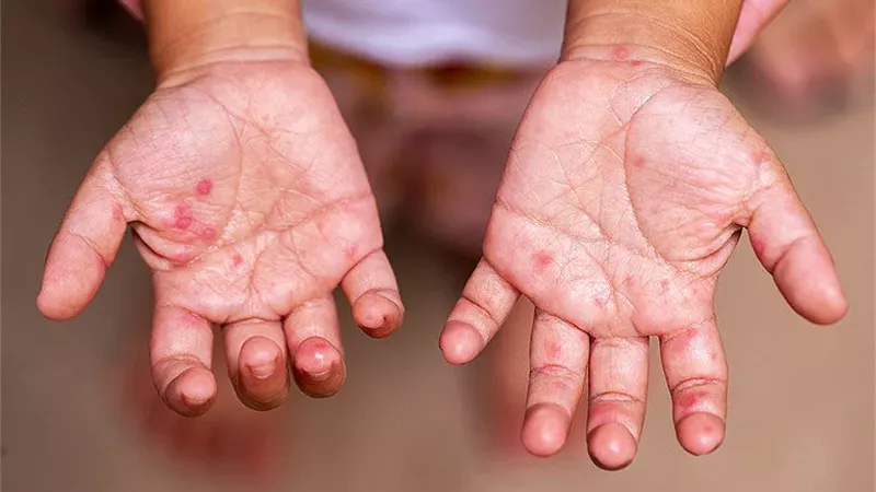 بعد رصد إصابة 4 طلاب.. ما هو فيروس HFMD وكيف ينتشر؟ 