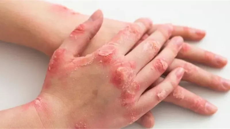 بعد إصابة 4 طلاب.. طرق الوقاية من فيروس HFMD 