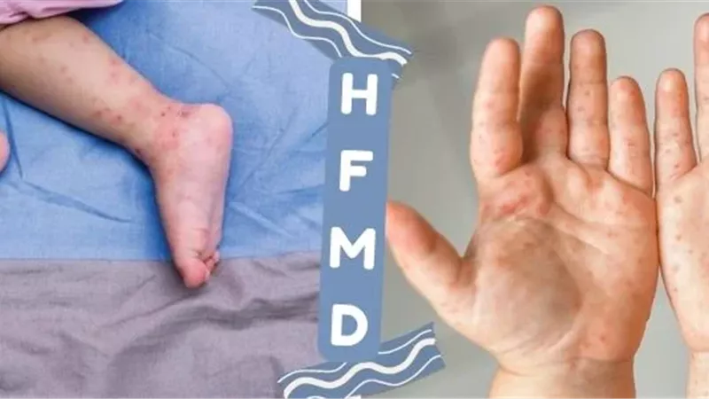 التفاصيل الكاملة لـ رصد حالات إصابة بفيروس HFMD في مدرسة سقارة بالجيزة