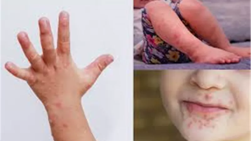 تعرف على أعراض فيروس (HFMD) وكيفية الوقاية منه