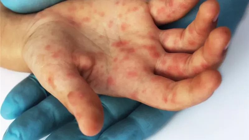 «مش هنقفل».. أول رد من وزارة الصحة على خطر فيروس HFMD بعد انتشاره في المدارس