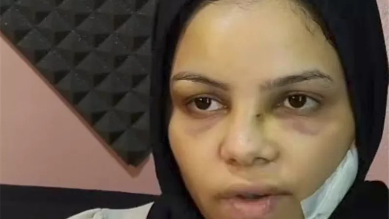 بسبب دعوى خلع.. زوج يشوه وجه زوجته بـ