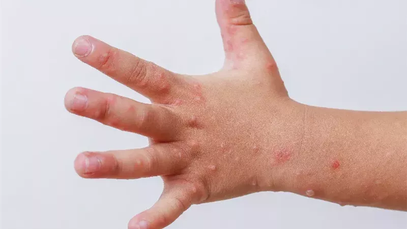 استشاري مناعة يكشف لـ«إيجبتك» طرق وقاية الأطفال من فيروس HFMD