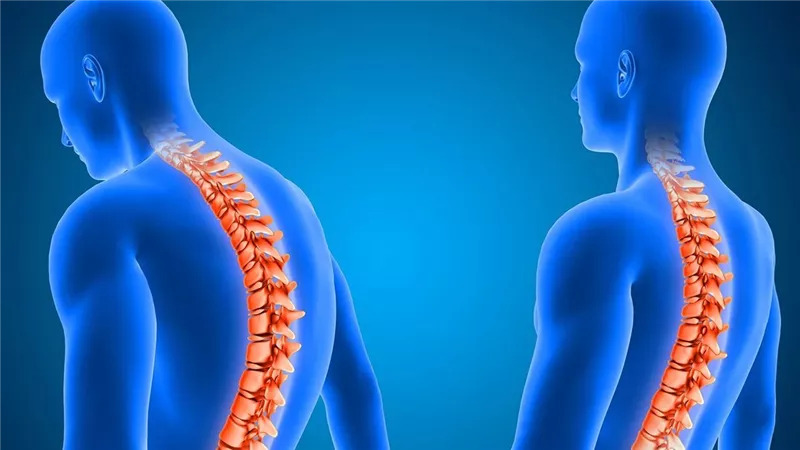 الصحة: 90% من حالات الانزلاق الغضروفي تتحسن بالعلاج التحفظي