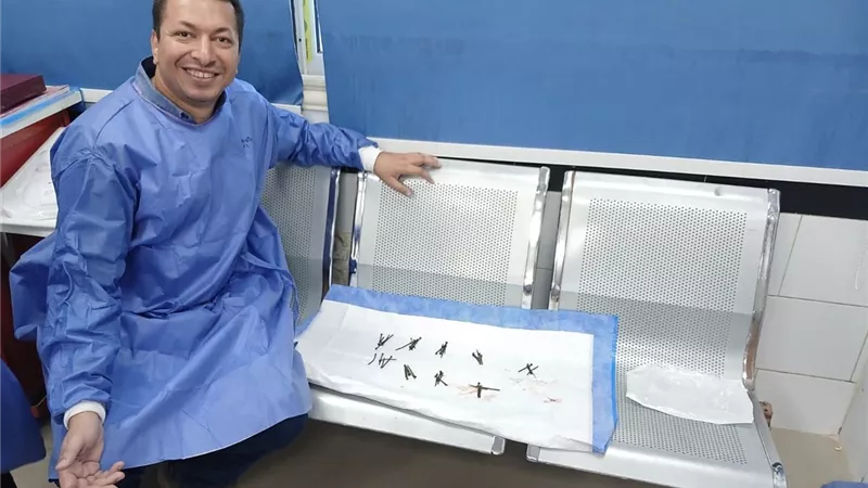 استخراج 100 مسمار وصامولة من معدة مريض بمستشفي جامعة بني سويف