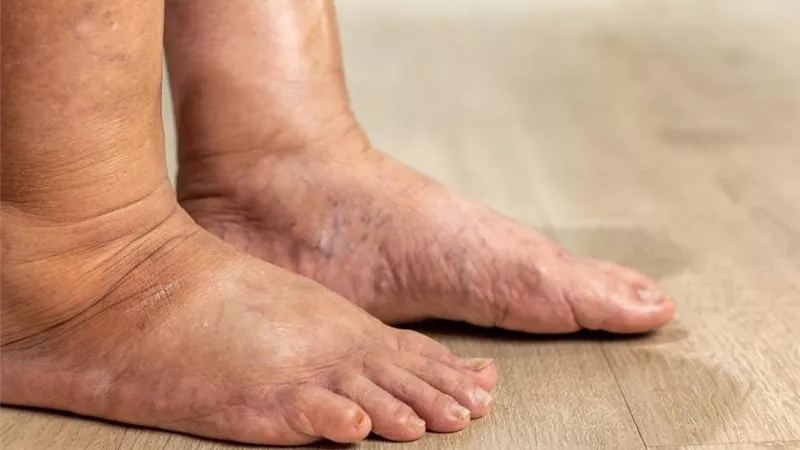 هل البتر الحل الوحيد لمضاعفات القدم السكري؟.. الصحة توضح|فيديو