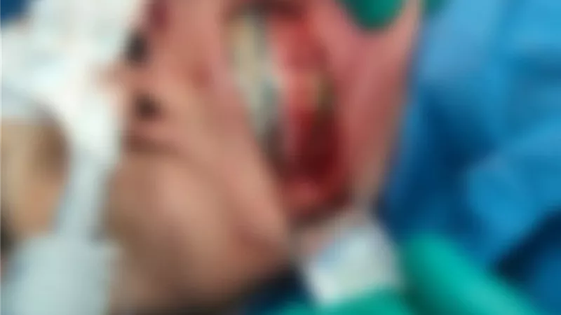 إنجاز طبي نوعي.. نجاح أول جراحة معقدة للوجه والفكين بمستشفى العدوة بالمنيا  