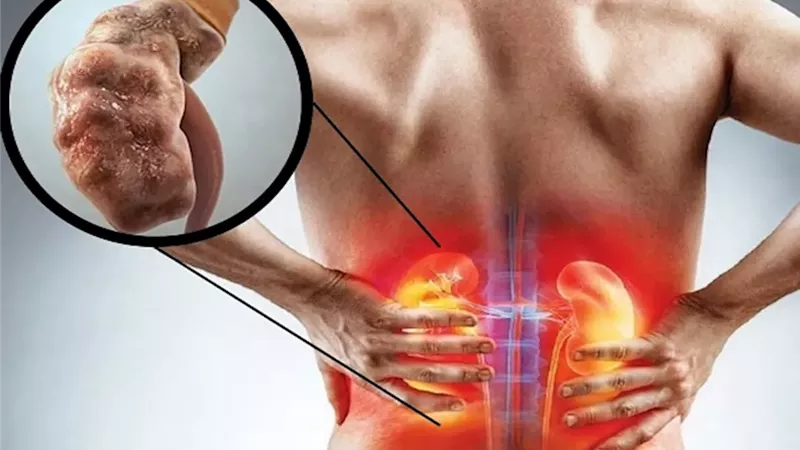 قبل ظهور الأعراض..الصحة تكشف أهم الفحوصات  للاطمئنان على صحة الكلى
