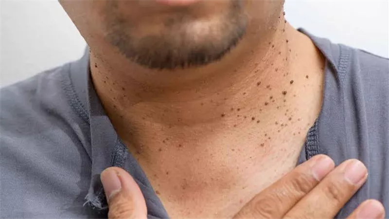 الصحة تحذر: الزوائد الجلدية المفاجئة قد تكون مؤشرًا لمشكلات صحية