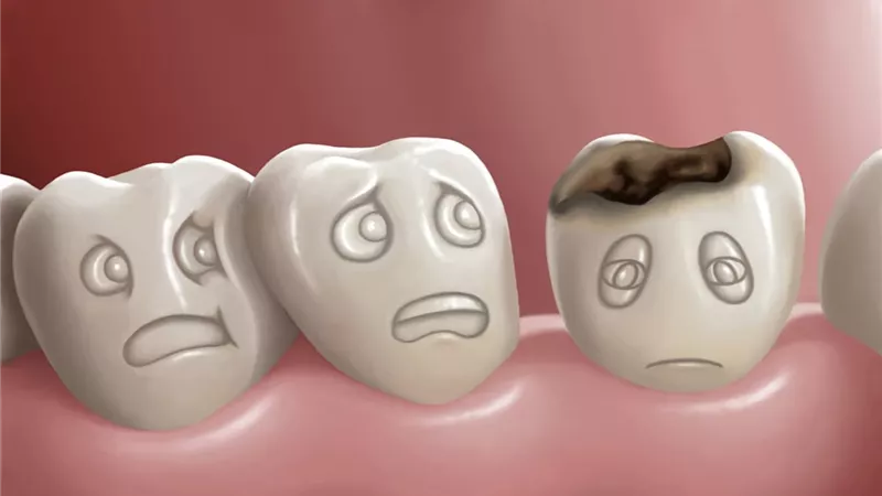 بدون حفر.. طريقة وقف تسوس الأسنان