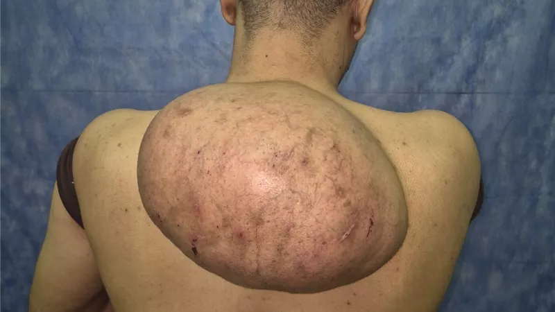 سوهاج الجامعية تنجح في استئصال ورم دهني ضخم يزن 15 كجم بنجاح