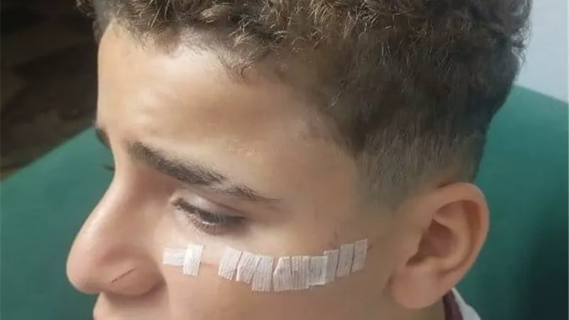 لو عاوزه تراضيني أعور ابنك.. طالب يشوه وجه زميله ب