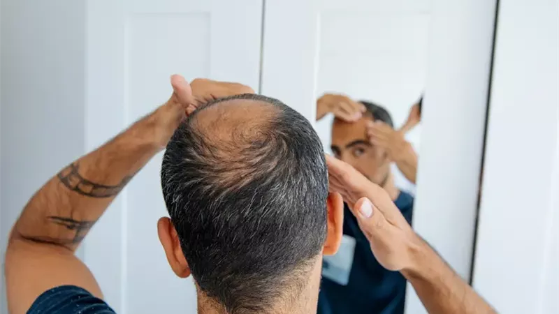 بشرى لأصحاب الصلع.. اكتشاف مستخلص نباتي نتائجه مذهلة