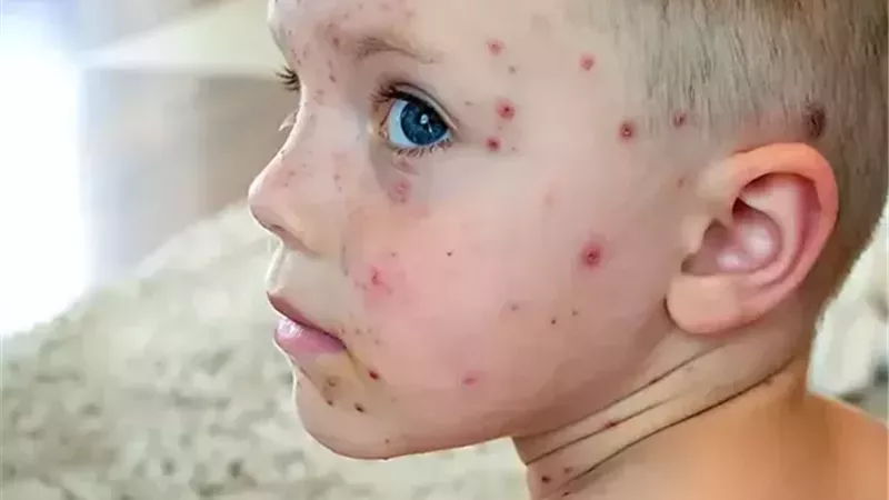 الجدري يصل مدارس المنوفية.. 10 إصابات في فصل واحد|خاص