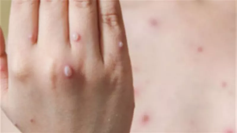 24 ساعة قلبت الموازين.. كيف انتشر الجدري المائي بين طلاب المنوفية؟
